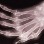 how to cure rheumatism permanently